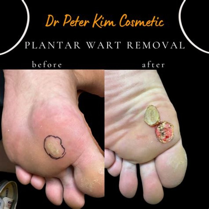 How does duct tape remove plantar warts?