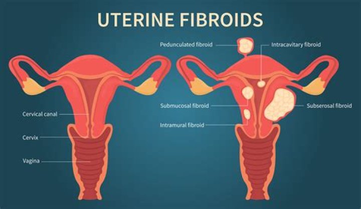 What is fibroid bleeding like?