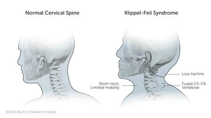 What is the Flipple technique?