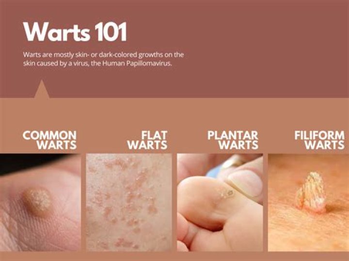 Why are my warts spreading?